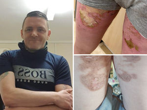 Supporting image for story: Hospital apologises as man left badly burned by heated mattress after surgery