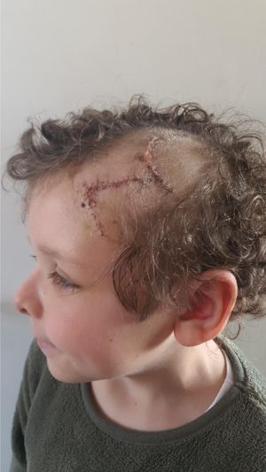 Noah Morris, then aged nine, suffered a fractured skull in the crash