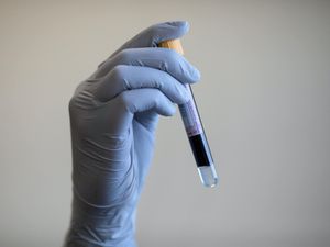 Supporting image for story: Blood test ‘could identify Covid-19 patients at greatest risk of severe illness’