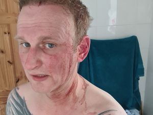 Supporting image for story: 'It was relentless, it wouldn't stop!' - Buzzard leaves Shropshire runner bloodied and bruised after attack in countryside