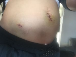 Chelsie was left unable to conceive naturally after the operation