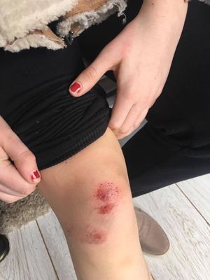 Her leg was also injured