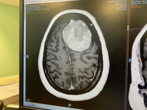 Supporting image for story: Doctors baffled that Walsall woman was 'walking and talking as she was' due to size of brain tumour