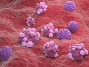 Supporting image for story: NHS hospital becomes first to offer new ovarian cancer surveillance test