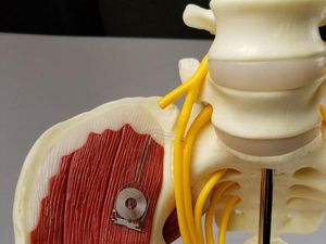 Supporting image for story: Implantable device speeds up nerve repair