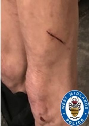 An injury to the man's leg