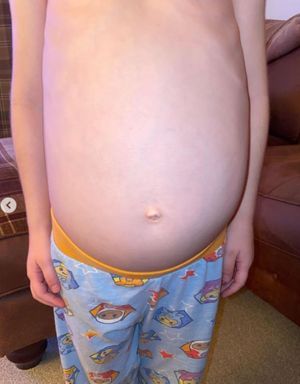 Dulcie before her operation. Photo: @dulcies_neuroblastoma_journey