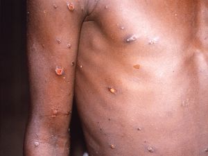 Supporting image for story: Government orders more mpox jabs as officials prepare for new strain