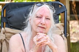 West Midlands gran Jean Hill was left with shingles after developing sun poisoning.