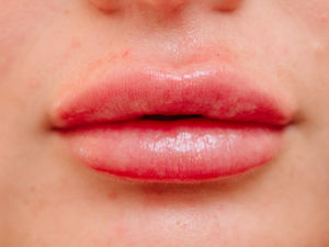 Supporting image for story: Sixteen-year-old given appointments for lip filler treatment illegally at three Walsall salons