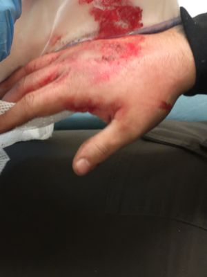 Jamie's injury photographed on the day he first went to hospital