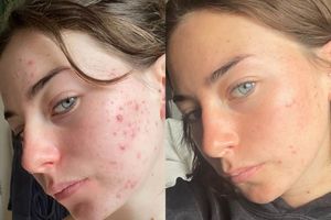 Supporting image for story: The science-backed skincare brand helping you fight breakouts and blemishes