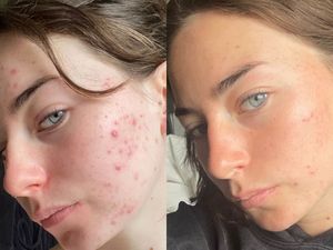 Supporting image for story: The science-backed skincare brand helping you fight breakouts and blemishes