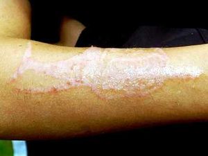 Supporting image for story: Boy left in agony by holiday henna tattoo