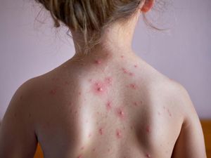 Supporting image for story: Vaccine for chickenpox to be rolled out on the NHS