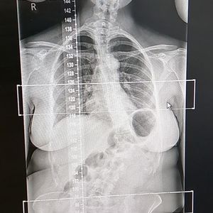 An x-ray of Mrs Alexander's spine