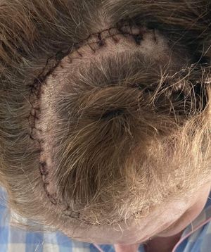 Helen Green's scar with stitches post surgery