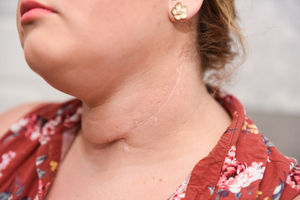 Liz had the ulcer on her tongue removed along with 58 lymph nodes in her neck