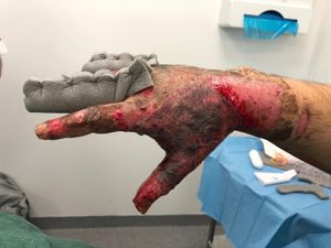 Supporting image for story: Burns victim backing fire safety campaign