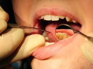 Supporting image for story: Hundreds of Shropshire children having decayed teeth out in hospital, report reveals
