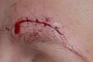 The victim required stitches
