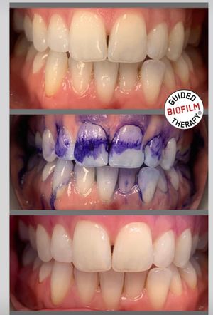 Guided Biofilm Therapy - before and after treatment.