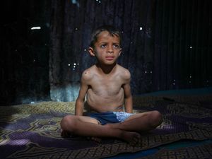 A child shows signs of malnutrition