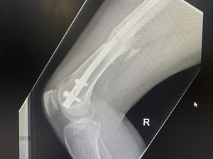 An x-ray of Ruth's broken leg.