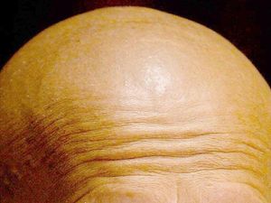 Supporting image for story: Premature balding a ‘bigger risk factor for heart disease than obesity’