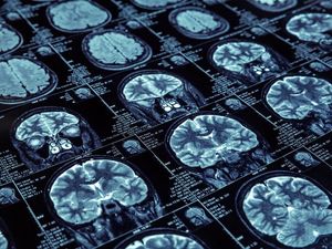 Supporting image for story: This supercomputer can detect brain tumours