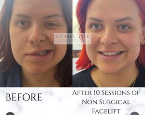 Lindsey Non Surgical Facelift Treatment For Bells Palsy And Clients With Aging Concerns