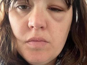 Supporting image for story: Patients with brain cancer express disappointment after drug rejected for NHS