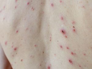 Supporting image for story: Minister urges take-up of chickenpox jab to defeat vaccine conspiracy theorists