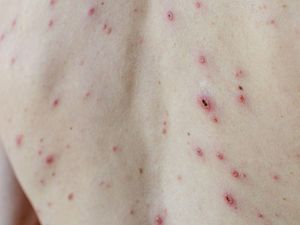 Supporting image for story: Minister urges take-up of chickenpox jab to defeat vaccine conspiracy theorists