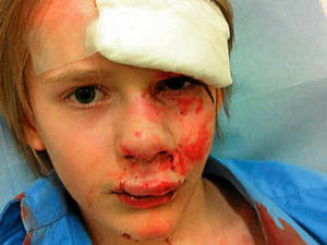 Supporting image for story: Face of Newport boy hit by car at 10mph