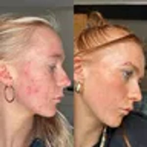 Why winter skin struggles – and the two-step routine people swear by to calm it