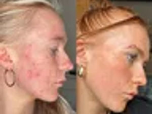 Supporting image for story: Why winter skin struggles – and the two-step routine people swear by to calm it