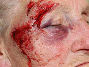 Supporting image for story: Battered and bruised at 90