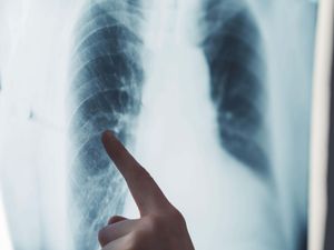 Illuminated lungs X-ray and a finger pointing at rib area