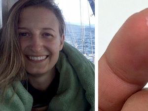 Supporting image for story: US woman pulls 14 worms out of her eye after becoming infected with a parasite that affects cattle