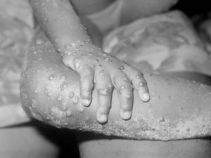 Supporting image for story: Number of monkeypox cases in UK rises to 57