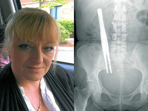 Supporting image for story: Six-figure payout for Kidderminster patient forceps blunder