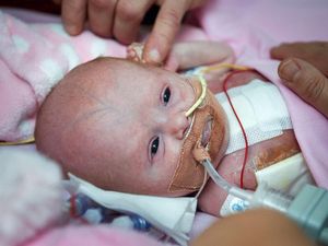 Supporting image for story: Miracle baby becomes first in the UK to survive being born with heart outside body