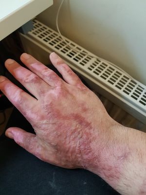 Michael had to have a skin graft on his right hand