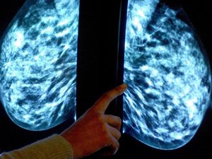 Supporting image for story: Figures show delays on breast cancer referrals