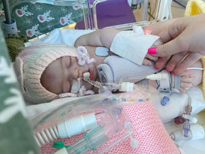 Supporting image for story: Lab-grown mini-lungs used to test new treatment for rare condition in babies