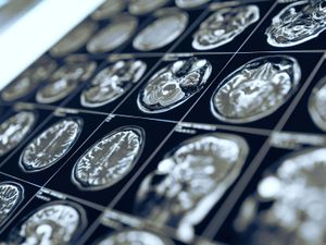 Supporting image for story: Breast cancer drug may slow growth of aggressive childhood brain tumour – study