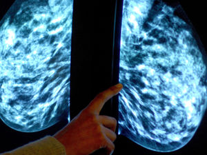 Supporting image for story: Thousands of women miss 'vital' breast cancer checks