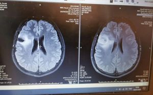 Scott Hinch brain scan