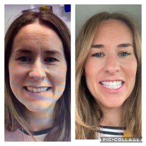 Claire - before & after Invisalign, teeth whitening and composite bonding by Dr Chet